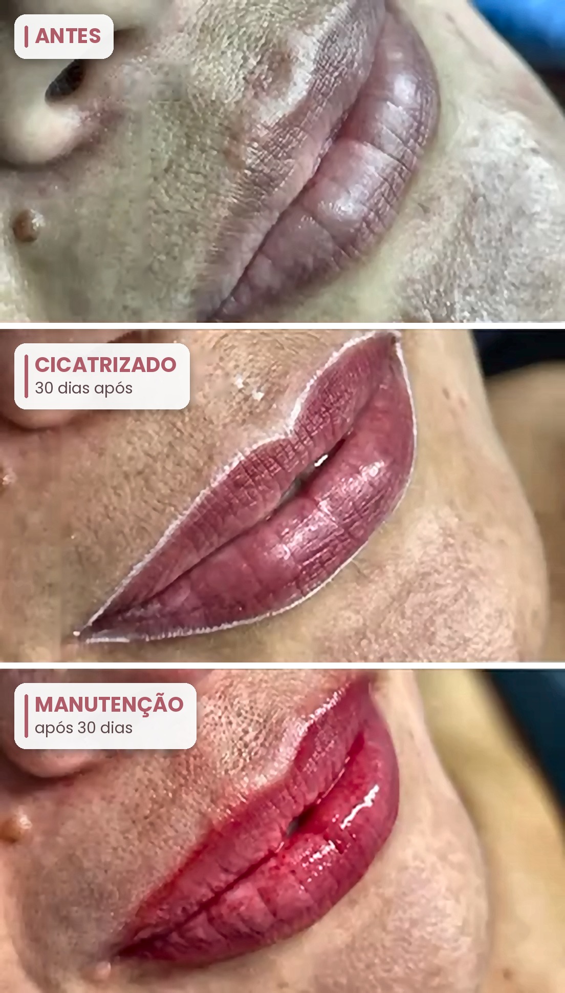 Sequência: lábios antes, cicatrizados 30 dias após e na manutenção